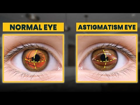 How To Manage and Treat Astigmatism in 2024? | Eye Expert Advice