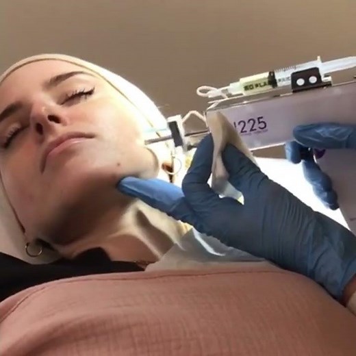 Mésothérapie du visage pour avoir une plus belle peau.