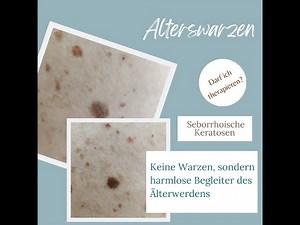 Alterswarzen, seborrhoische Keratosen einfach erklärt. Darf man da therapieren?