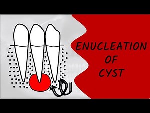 ENUCLEATION OF CYST || ORAL SURGERY || ORAL MEDICINE AND PATHOLOGY || DENTAL CLASSES BY DENTAL CAFE