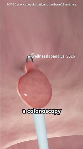Colonoscopy Procedure Explained | The Camera That Goes Inside You And Saves Your Life!#colonoscopy