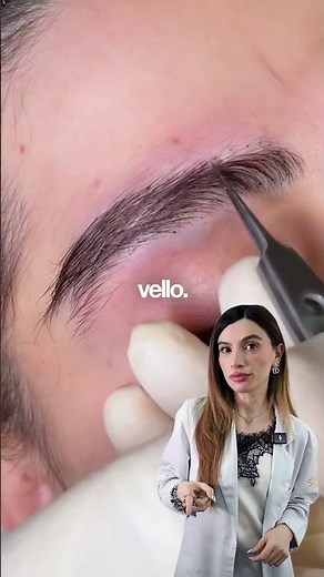 Injerto de cejas.