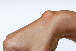 Wrist cysts: what they are and how to treat them | Emergency Live