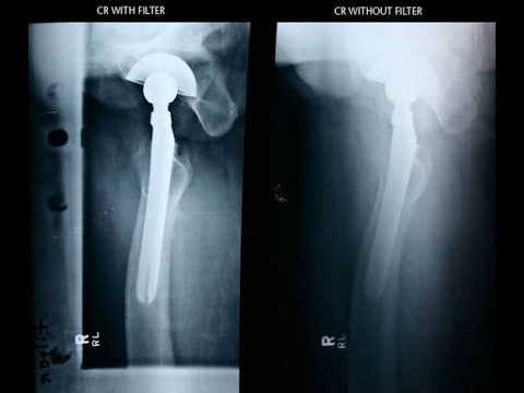 Axiolateral projection of hip without compensating filter And with Ferlic swimmer’s filter