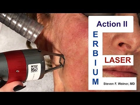 Action II Erbium Laser