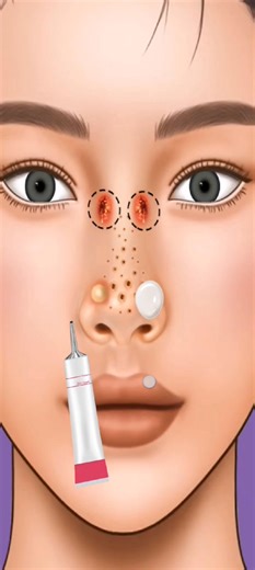 18K views · 140 reactions | Nose Infection Gone Wrong  | Pimple Popping Nightmare! #NoseInfection #PimplePopping #SatisfyingVideo #Skincare #PimpleTreatment #ViralVideo #NoseCare #DrPimplePopper #SkincareTips #SatisfyingContent #InfectionRemoval #GrossButSatisfying #BeforeAfter #HealthTips #BeautyCare | ASMR | Facebook