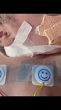 How To make Prostin (Alprostadil) infusion in neonate (Simplified) #neonatology #neonatalicu