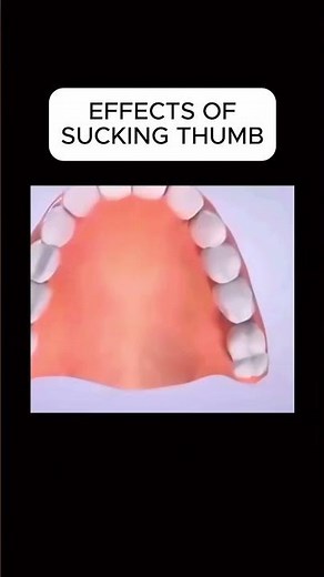 EFFECTS OF SUCKING THUMB