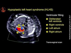 Fetal echocardiography at 11-13 weeks: Hypoplastic Left Heart Syndrome (HLHS) • Video • MEDtube.net