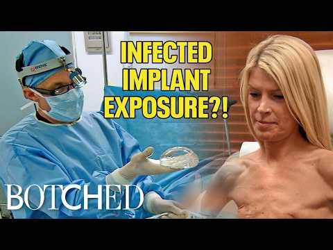 Exposed Infected Implants Leave Marla With NO Boobs (Before & After) | Botched | E!