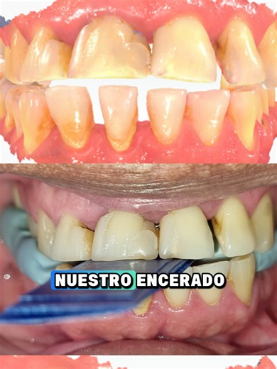 🦷 ¿Solo usas la lámina de Long para registrar relación céntrica? Te estás perdiendo una gran herramienta clínica. 👀 ✅ Desprograma la musculatura ✅ Mejora la precisión de la relación céntrica ✅ Ayuda a determinar la DVO ✅ Optimiza el flujo analógico y digital 📌 La odontología digital empieza con registros clínicos precisos. #OclusionDental #RehabilitacionOral #LaminaDeLong #OdontologiaDigital #Exocad #ProtesisDental #Dentista #Odontologia #Articulador #FlujoDigital