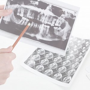 Bone Grafting for Dental Implants | Expert Care