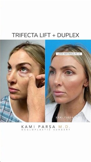 Eye Bag & Skin Rejuvenation Transformation | Dr. Kami Parsa