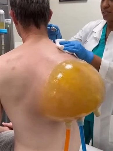 Giant Lipoma Removal Surgery: What You Need to Know