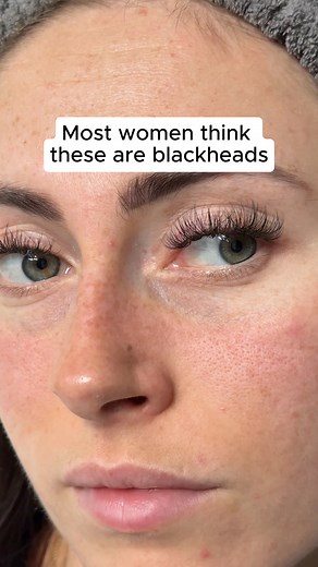 Sebaceous filaments ≠ blackheads ❌ Your pores need a smarter solution 💡 Stick on a nose patch before bed and wake up to clearer, smoother, brighter skin 💖 Shop now with 60-day guarantee 👉 https://vueswiss.com/products/hydrocolloid-nose-patches | Vue Skin