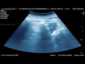 GYN : IUCD LOOP IS IN SITU 2025 11 19 16 29