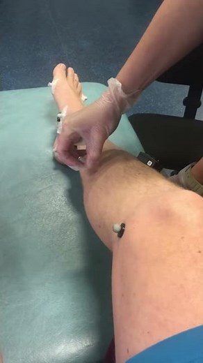 Indwelling EMG into Tibialis Posterior