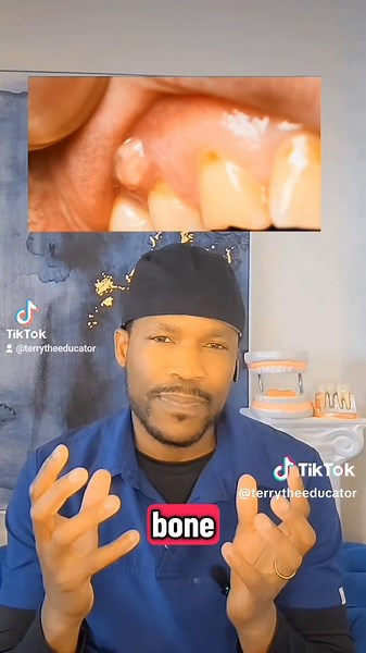 Understanding Dental Fistulas: Causes and Treatments