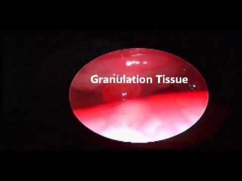 Tracheostoma Granulation Tissue Resection
