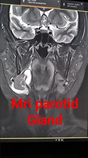 MRI Oral Cavity and Parotid Gland Anatomy & Pathology |