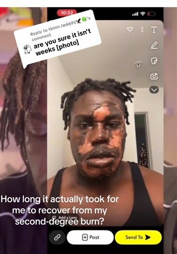 Replying to @łàmìn.łøŵķêÿ🦅🍀 How long it actually took for me to recover from my second-degree burn?🔥 #fyp #explorepage #relateable #trusttheprocess #recovery 🙏🏾✨