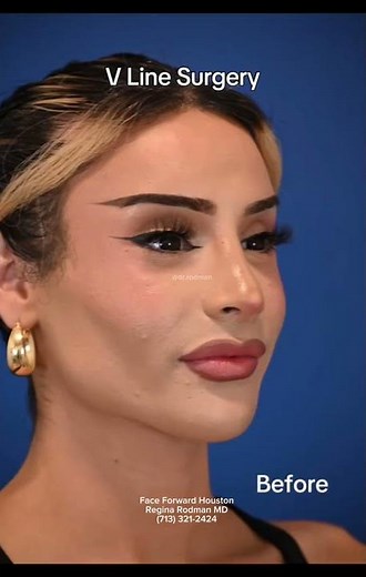 Jaw Reduction|Vline Surgery| Facial Plastic Surgery