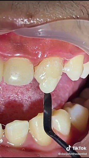 Transform Your Smile with Vampire Teeth - Dental Tips