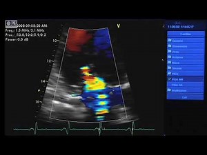 Measure PISA in Mitral Regurgitation