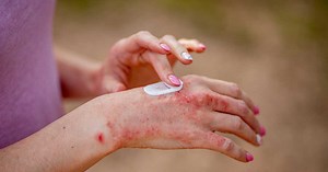 Cortisone en crème : indications, prescription, effets secondaires
