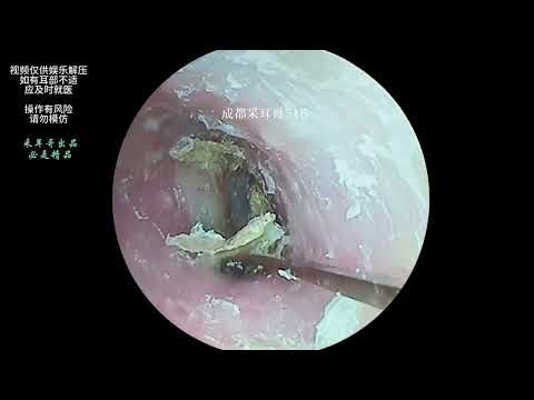 ASMR: Asmr Ear Cleaning | Most Satisfying Earwax Removal ASMR Ever