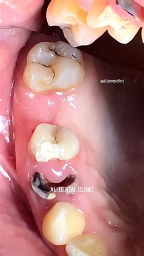 Ali Dental Clinic on Instagram: "Root Canal Treatment Followed by Composite Restoration ⭐🦷"