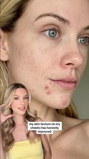 VI Peel Before & After