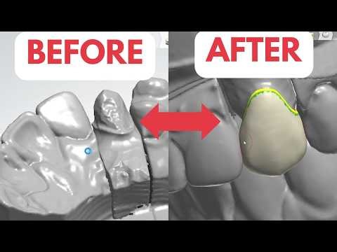 Stunning Upper Canine #11 Crown – Complete 3Shape Workflow
