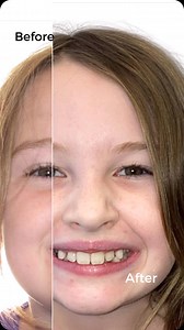 PHASE I TRANSFORMATION TUESDAY朗 PHASE I EARLY INTERVENTION DEEP OVERBITE SEVERE CROWDING The team at Get It Straight Orthodontics focus on patient comfort and long-term results. At times, that can include early treatment. Seeing our patients’ journeys from start to finish is what makes orthodontics so rewarding! ✨朗✨ Interested in your own SMILE Transformation? Call us today to get started! 585-248-5100 | Get It Straight Orthodontics | Facebook