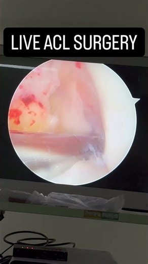 How to Prepare the Femoral ACL Footprint (Arthroscopic Technique) #acltear #arthroscopy #keyhole