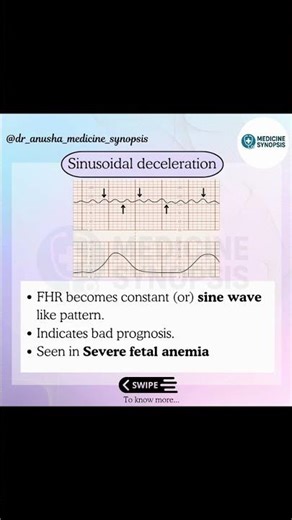 FHR Decelerations | High-Yield for NEET PG/INI-CET/FMGE #neetpg #fmge #trending #viral #shorts