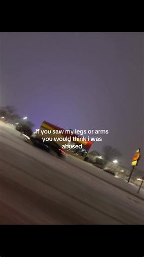 Understanding Bruises: The Reality Behind Easy Bruising