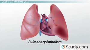 Peripheral Venous Disease: Symptoms & Treatment - Video | Study.com