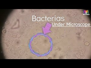 Bacteria seen under Microscope.Bacteria in urine.Nitrite Positive.Severe UTI. Urine tract infection.