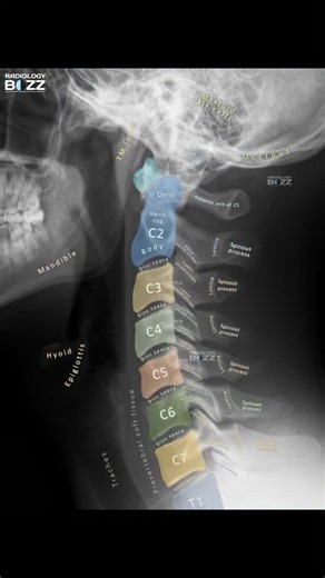 𝗥𝗮𝗱𝗶𝗼𝗹𝗼𝗴𝘆 𝗕𝘂𝘇𝘇 on Instagram: "CERVICAL SPINE X-RAY – LATERAL VIEW (ANNOTATED) This annotated lateral cervical spine radiograph beautifully demonstrates the anatomy from C1 to T1, including key landmarks such as the dens (odontoid process), Harris ring, vertebral bodies, intervertebral disc spaces, lamina, pedicles, spinous processes, and prevertebral soft tissues. 📌 Important Note for Radiology Professionals: ✔ Always assess cervical alignment (anterior vertebral line, posterior ve