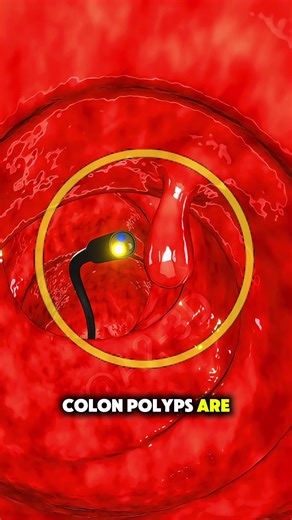 How Colon Polypectomy During Colonoscopy (3D Animation) Colon Polypectomy is performed to remove abnormal growths in the Colon. Doctors use a colonoscope with special tools to cut and remove the polyps. This helps prevent the development of colorectal cancer. #polypectomy #colonoscopy #coloncancer #medicalanimation #3danimation