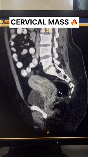 Cervical Cancer CT with Necrosis #shorts
