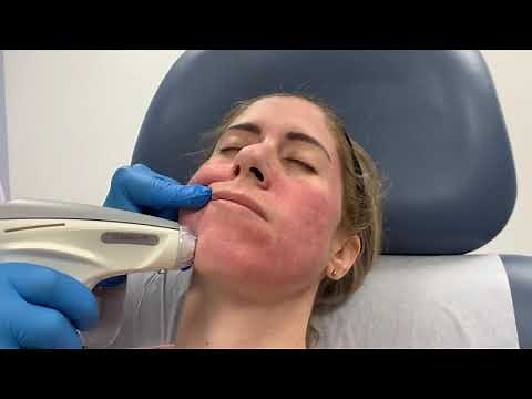 eMatrix: Sublative "laser" skin rejuvenation with PRP for enlarged pores and uneven skin texture.