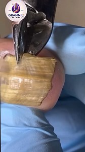 Best Nail Practices for Curved Nails Without Cutting or Filing 🪷🌸 #seniorhealth #noninvasive #footcare | Grand15