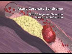 Overview of Coronary Artery Disease