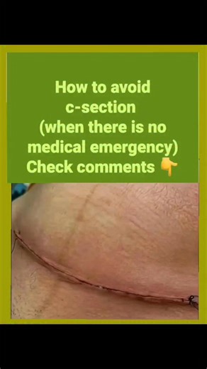 how to reduce your chances of c-section (when there is no medical emergency) let’s be clear first 👇 a c-section can be life-saving. but many are done because of preventable factors. here’s what truly helps 📝 📝 1. start antenatal care early early and regular clinic visits help detect problems before they turn into emergencies (high bp, big baby, infection, anemia). 📝 2. manage your weight excess weight increases risk of: – big baby – prolonged labor – failed induction all of these raise c-sec