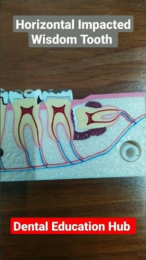 Horizontal Impacted Wisdom Tooth