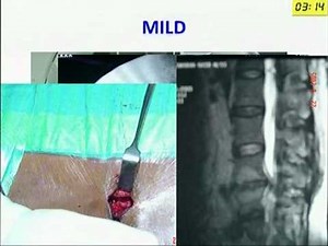 Intervertebral Disc Prolapse