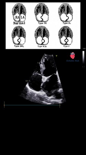 103K views · 890 reactions | 易 Aneurysmal Interatrial Septum (IAS) –...