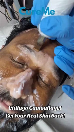 🤍 VITILIGO CAMOUFLAGE — HELPING CREATE A MORE EVEN-LOOKING SKIN TONE ✨ Living with vitiligo can affect how you feel about your skin. Vitiligo camouflage is a specialized cosmetic technique designed to help reduce the visible contrast between depigmented areas and surrounding skin. ✨ Customized to your skin tone 🎯 Focused on improving visual uniformity 🩺 Personalized assessment before treatment 💫 Designed with natural-looking results in mind Every skin is different, so suitability and expecta